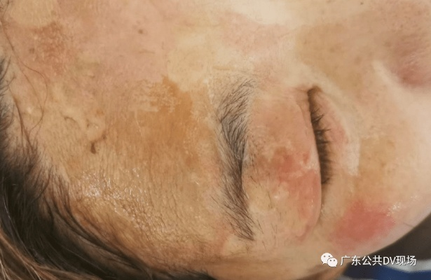 赫莲娜护理致脸部烧伤事件引发的深度思考