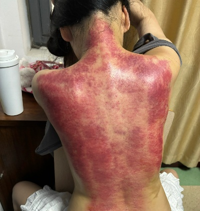 无语哥重庆刮痧体验，痛苦面具的挑战之旅