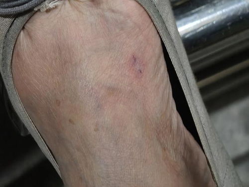 男子散步穿拖鞋遭毒蛇咬伤事件