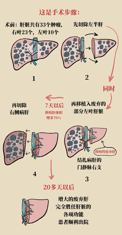 重庆完成首例成人亲体辅助肝移植手术，生命的新希望启程