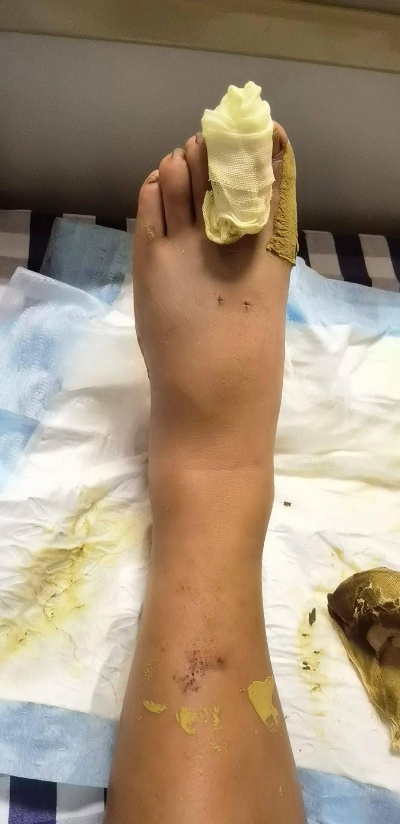 男子蛇咬险象环生，就医途中意外摔倒